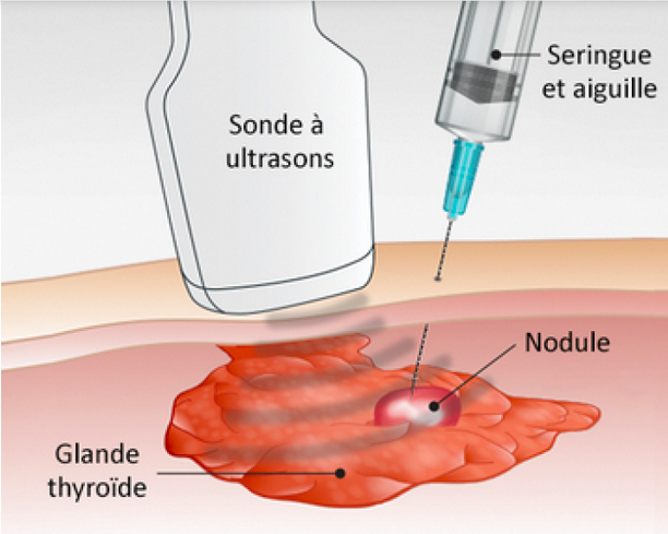 Cytoponction thyroïdienne | Cimep