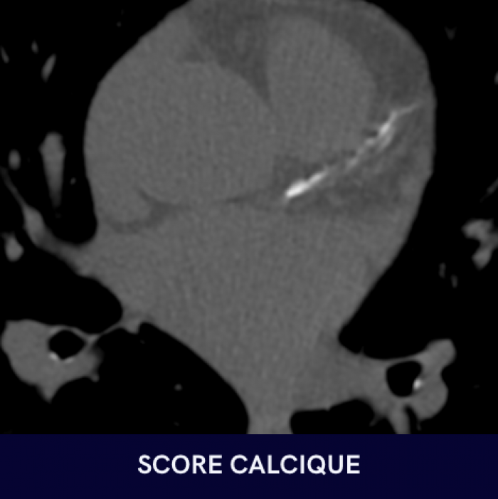 Calcification coronarienne