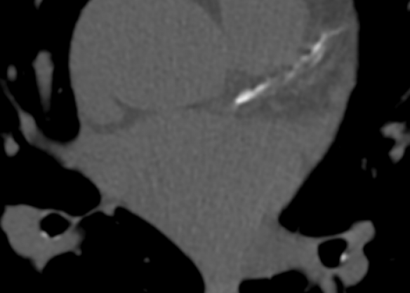 Calcification coronarienne